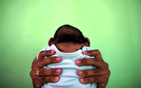 Image: A 4-month-old baby born with microcephaly