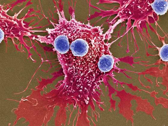 T lymphocytes and cancer cells, SEM