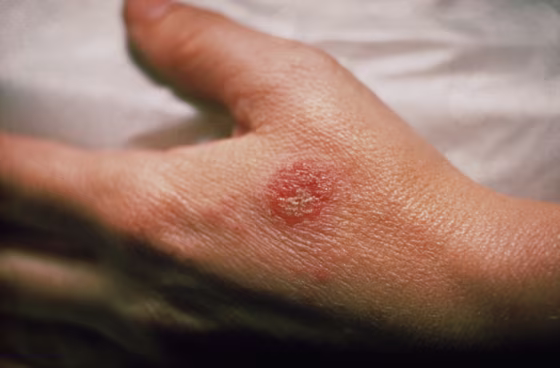 Nummular Eczema