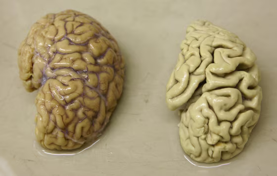 Image: Half a healthy brain is pictured next to half a brain of a person suffering from Alzheimer disease Belle Idee University Hospital in Chene-Bourg