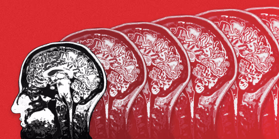 Image: Could inflammation be the key to finding a drug to treat Alzheimer's disease?
