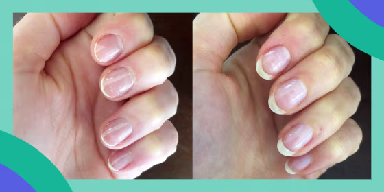 The NailTek Nail Recovery Kit includes a ridge filler, a strengthener and a nourishing cuticle oil.