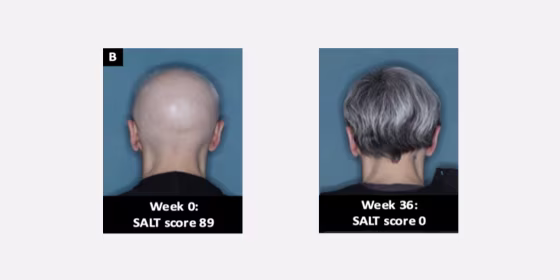 The Food and Drug Administration approved baricitinib, a once-a-day pill developed by the drugmaker Eli Lilly to treat alopecia areata, an autoimmune disease that triggers sudden hair loss. 