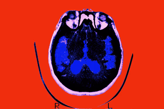Scan of the brain of a patient affected by Alzheimer's Disease in an axial section.