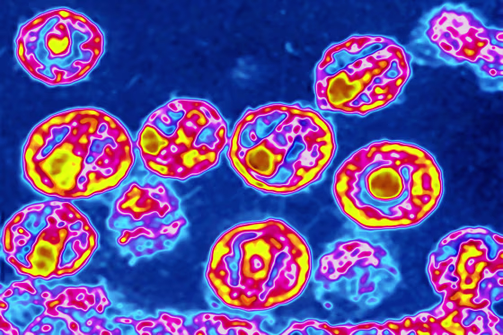 Colorized electron microscope image of the HIV virus. Here, the genetic material Of several viruses can be distinguished in a cone shape in the center of the virus.