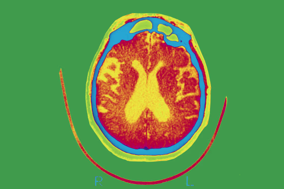 Scan of the brain of a patient affected by Alzheimer's disease.