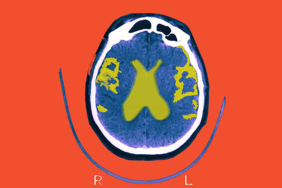 Scan of the brain of a patient affected by Alzheimer's.