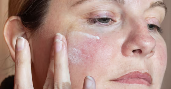 Environmental and emotional factors, including stress, heat and spicy foods, can be major triggers for rosacea flare-ups.