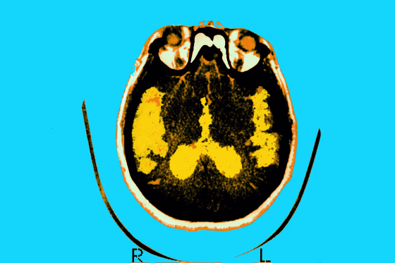 Axial section scan of the brain of a patient affected by Alzheimer's 