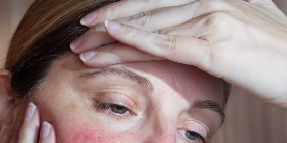 Dermatologists said the best way to avoid and treat acne scarring is by first treating the acne itself.