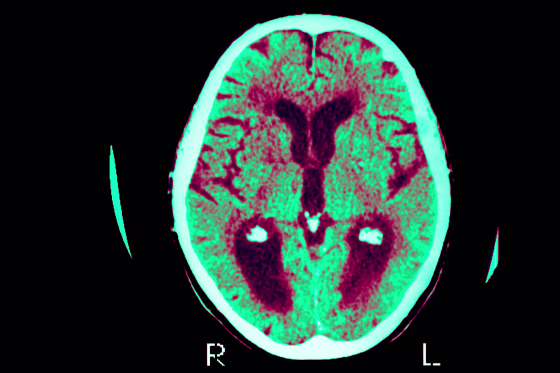 In Alzheimer’s, nerve cells in the brain at some point start to dysfunction, leading to debilitating memory loss.