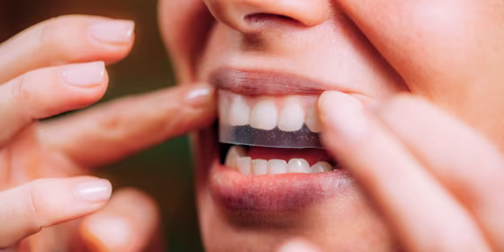 To maintain your results, it’s crucial to consistently use teeth whitening strips after your first treatment, and supplement with whitening toothpaste, mouthwashes or gels.
