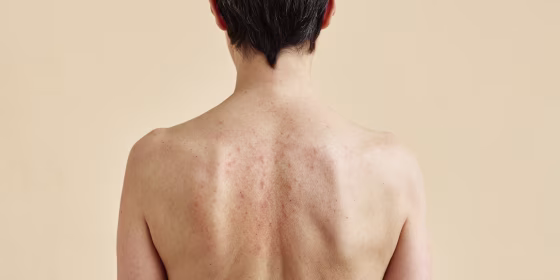 According to dermatologists, the first step in addressing acne is using a cleanser specifically formulated for body acne.