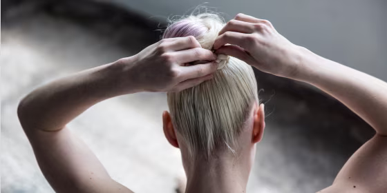 Traction alopecia is a form of hair loss caused when continuous tension is placed on hair strands.