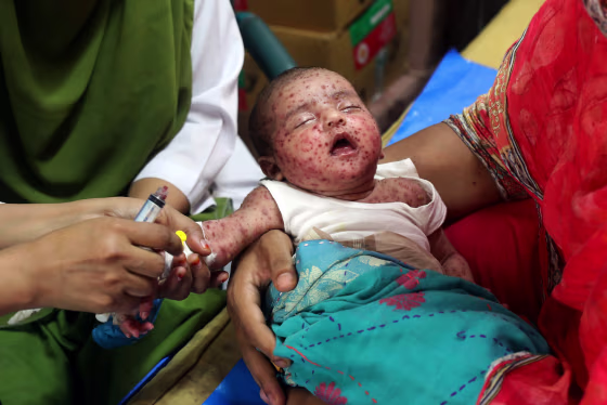 Image: A baby with measles in the arms of a woman at a hospital.