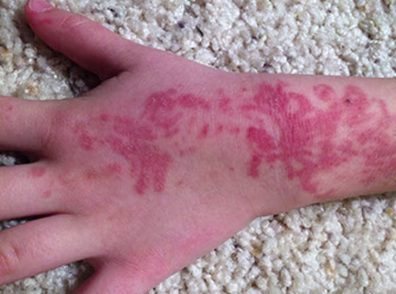 A 5-year-old developed severe reddening where the tattoo was placed.