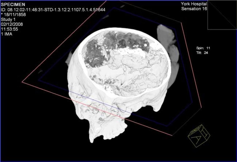 In this decapitated skull from around 300 B.C., found in mud, researchers used a CT scan to show brain material (the dark folded matter at the top of the head). The lighter colors in the skull represent soil. Credit: York Archaeological Trust