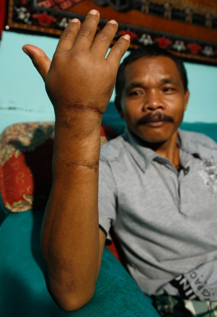 In this photo taken on April 30, 2009, Main, a park ranger who survived a komodo dragon attack shows his swollen hand at his house in Labuan Bajo, Indonesia. Attacks on humans by Komodo dragons _ said to number at around 2,500 in the wild _ are rare, but seem to have increased in recent years. Komodo dragons have a fearsome reputation worldwide because their shark-like teeth and poisonous saliva can kill a person within days of a bite. (AP Photo/Dita Alangkara)