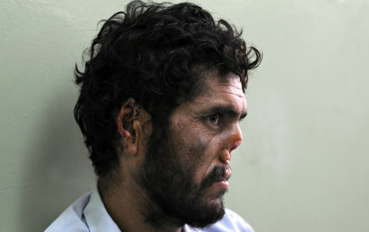 Image: An afghan man whose nose and ears were cut off by the Taliban