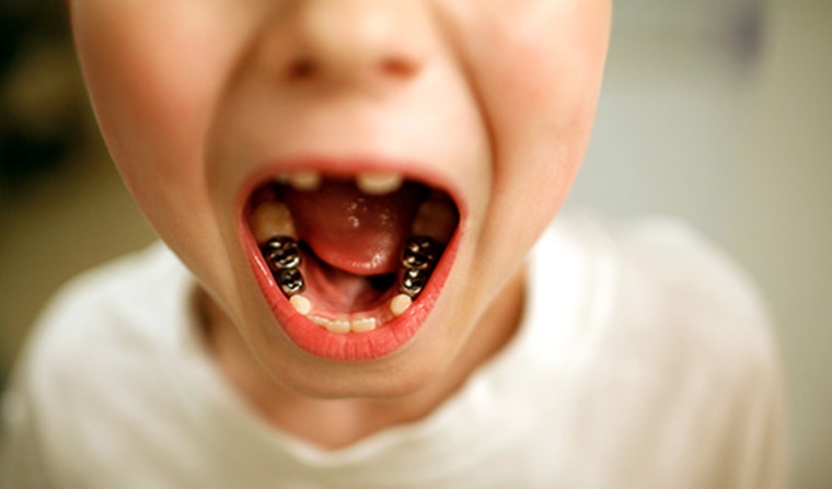 Ryan Massey, 7, shows his capped teeth. Dentists in the area of Charleston, W.Va., say pollutants in drinking water have damaged residents’ teeth.