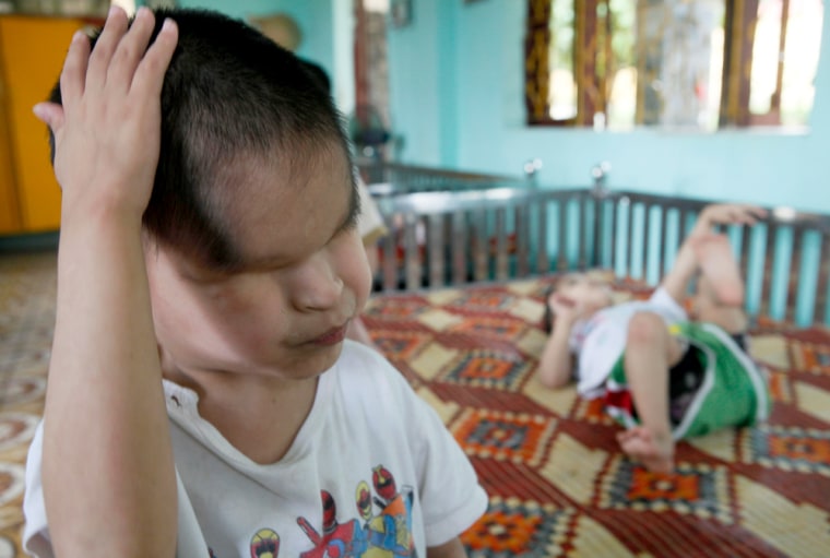 Image: Nguyen Tuan Tu, a second generation Agent Orange victim who was born without eyes