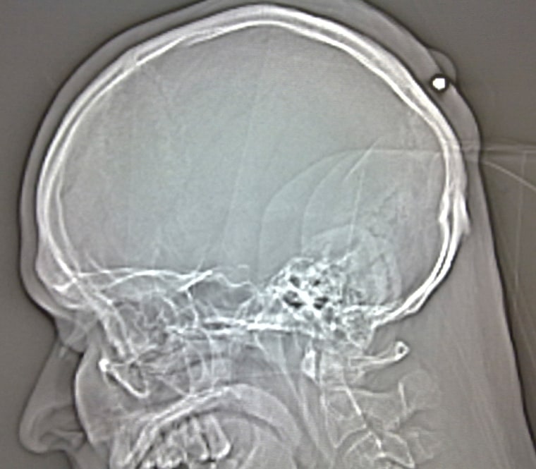 Image: X-ray of the skull of a man with a bullet  in the back of his head