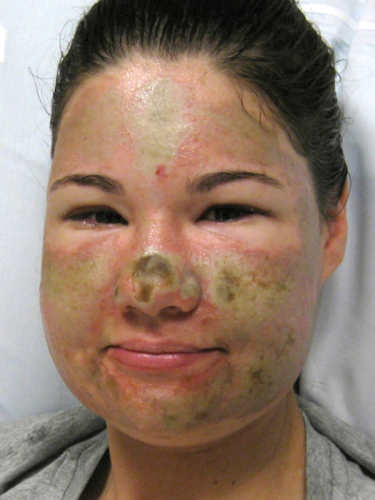 Image: Acid attack victim Bethany Storro