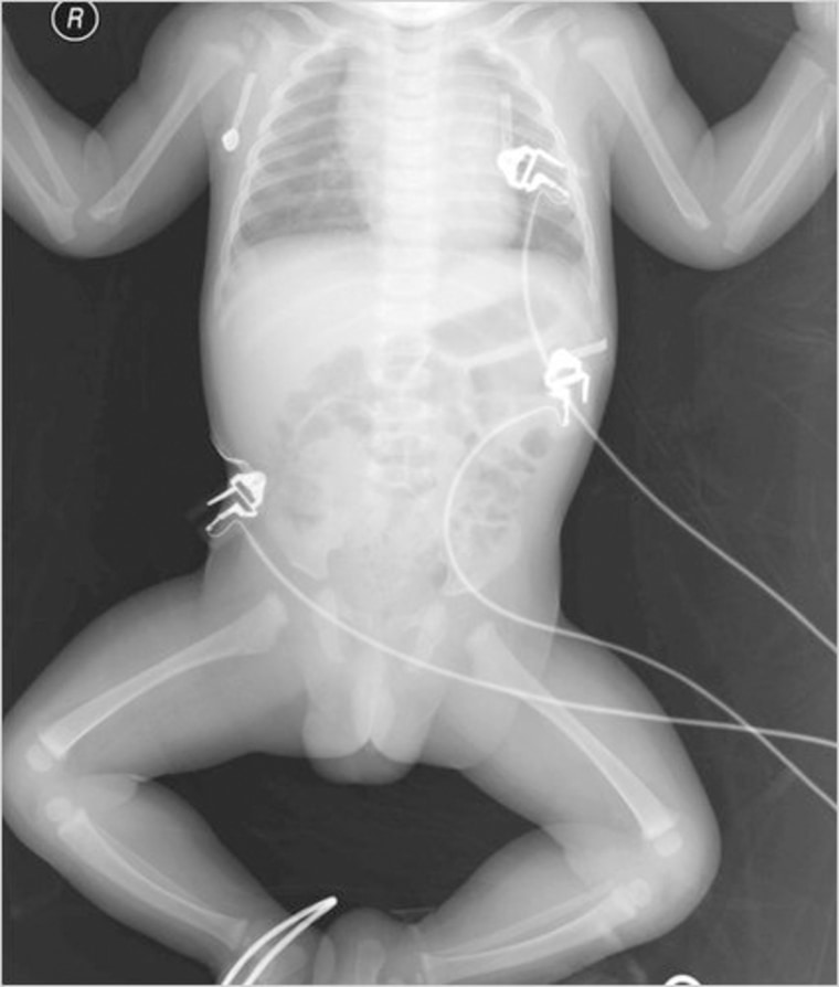 This reproduction of a "babygram" - a full-body X-ray of an infant - is from an article on detecting child abuse that appeared in a medical journal. Babygrams have long been out of favor because of radiation dangers; the article describes their use as "a serious flaw." At SUNY Downstate Medical Center in Brooklyn, technologists took babygrams of premature infants even though only chest X-rays had been ordered. The State Health Department is now investigating.