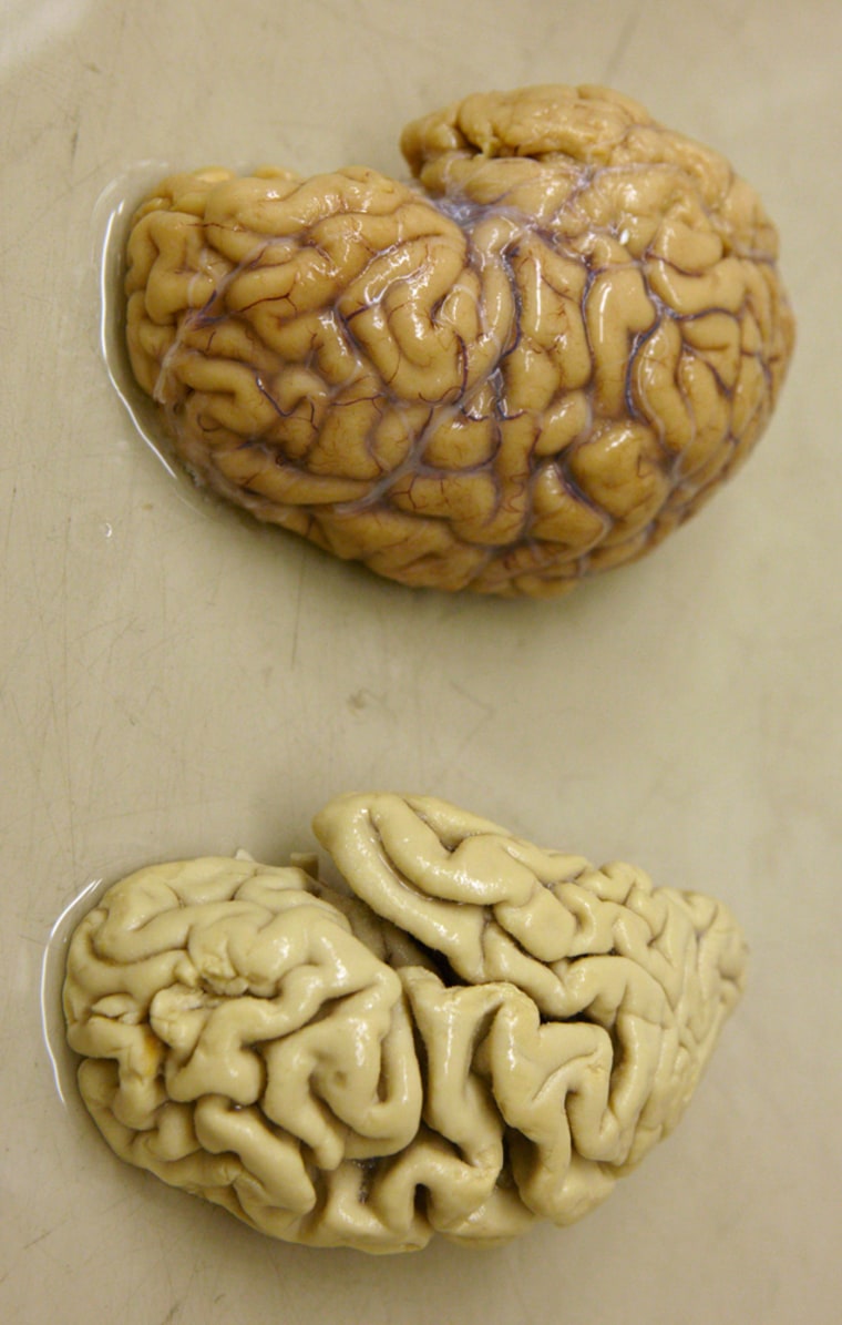 Image: One hemisphere of a healthy brain (above) is pictured next to one hemisphere of a brain of a person suffering from Alzheimer's disease (below), .