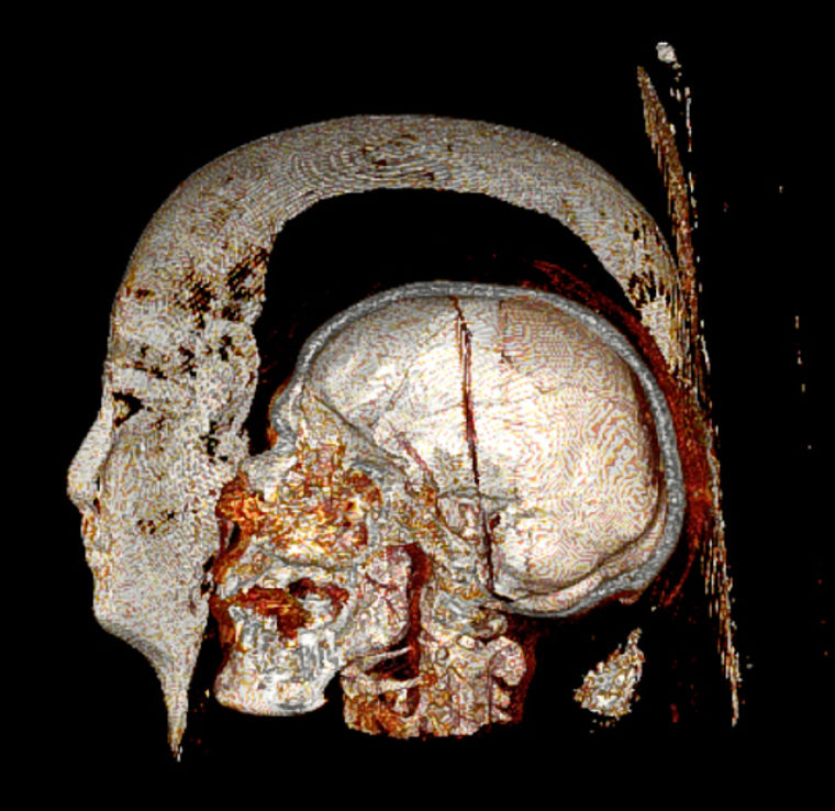 The ancient Egyptian mummy Djeher as imaged with a CT scanner. Djeher was found to have heart artery and other vascular disease. Djeher lived between 304 and 30 BC. Another mummy with coronary artery disease, Princess Ahmose-Meryet-Amon, lived between 1580 and 1550 BC and is the oldest known case of human heart disease.