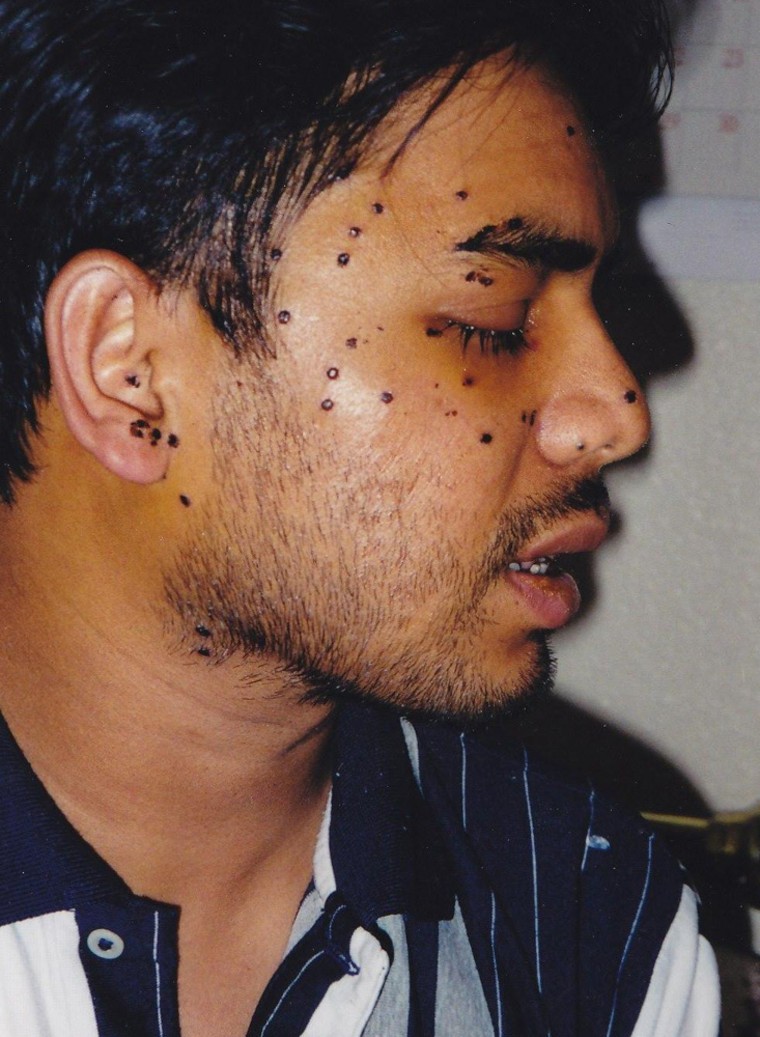 Rais Bhuiyan recovering from the gunshot wounds to his head.