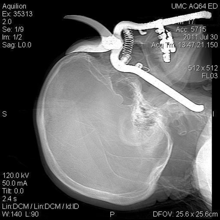 Image: A CT scan shows a pair of pruning shears embedded in the head of an 86-year-old Green Valley, Ariz., man