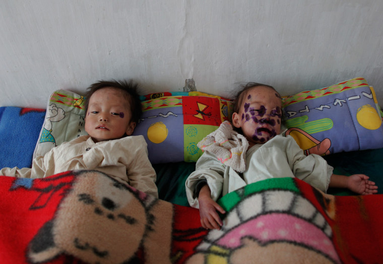 Image: North Korean children suffering from malnutrition rest in a hospital in Haeju
