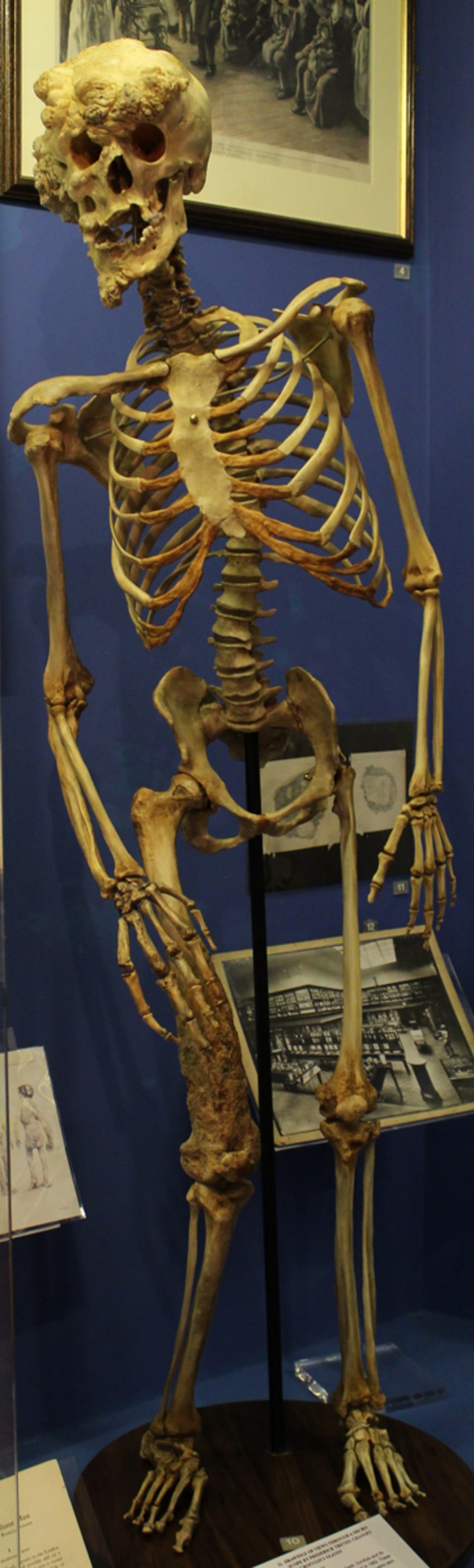 A replica of the skeleton of Joseph Merrick, known as the Elephant Man, at the Royal London Museum.