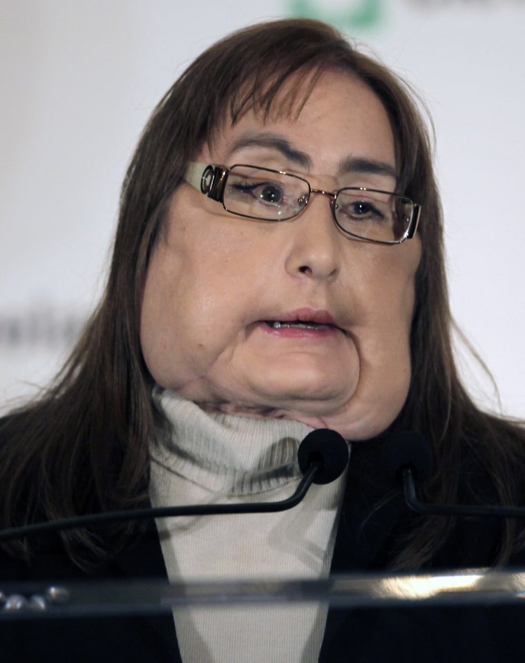 Connie Culp, who underwent the first face transplant surgery in the U.S., speaks to the media at a news conference at the Cleveland Clinic in Cleveland,  on Tuesday, May 5, 2009. The 46-year-old mother of two lost most of the midsection of her face to a gunshot in 2004. The initial surgery by the Cleveland Clinic team took place in December 2008.  (AP Photo/Amy Sancetta)