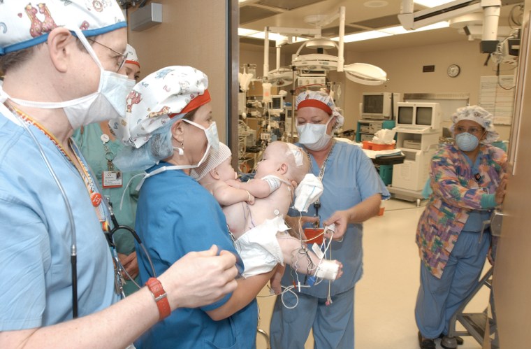 Conjoined Twins Surgery at Childrens Hospital Los Angeles