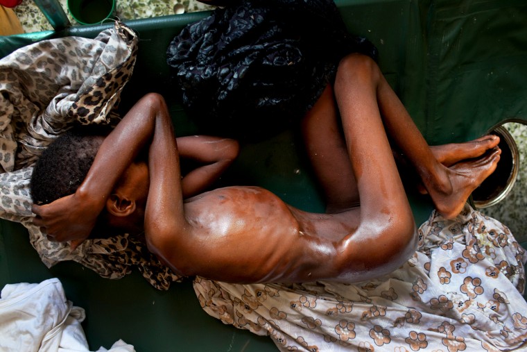 Image: A malnourished child in a hospital in Mogadishu, Somalia.