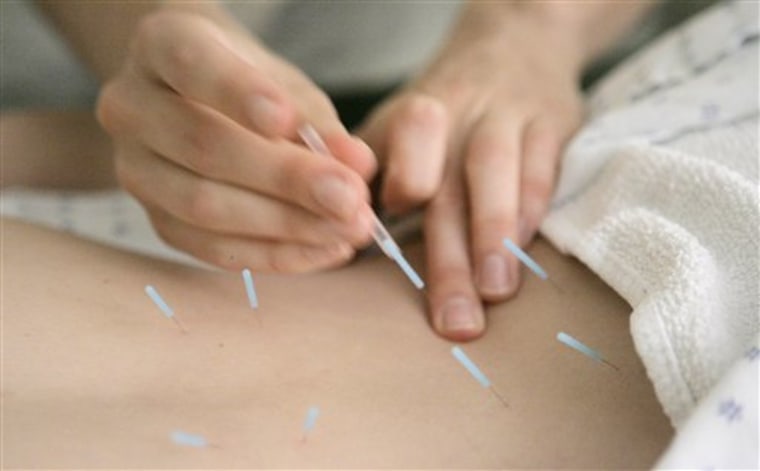 Back Pain Acupuncture