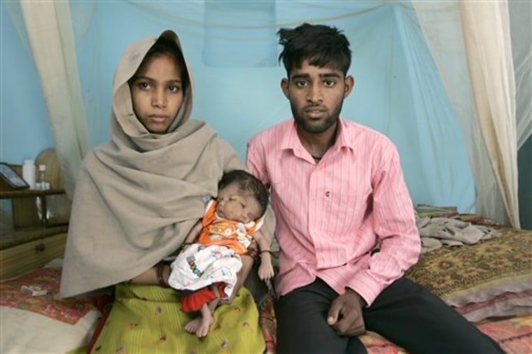 Two-faced baby's family refuses special care