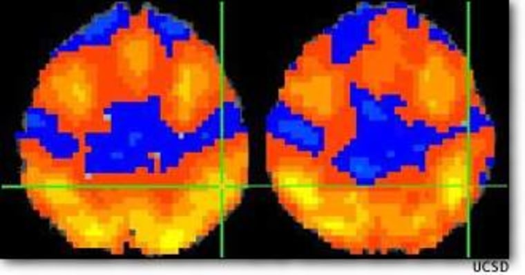 Brain imaging found differences between activity patterns for women who were not alcoholics, at left, and alcohol-dependent women, at right. Could imagery be used to identify alcoholics?