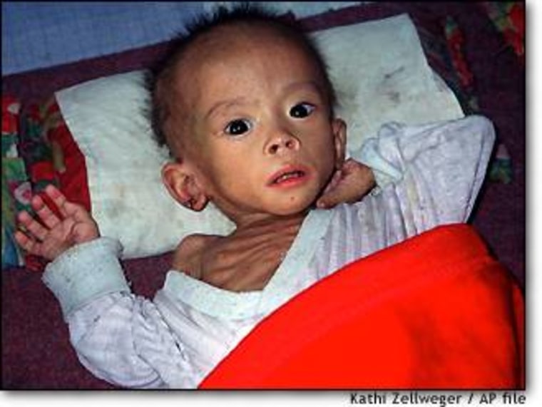 The image, provided by the charity Caritas Hong Kong, shows a malnourished child at a baby home in Pyongsong City, North Korea on Aug. 8, 2002.