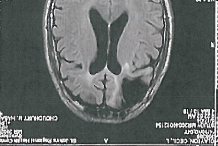 A brain scan shows the missing portion of Cecil Claytonâs brain. Clayton suffered brain damage in a sawmill accident that required one-fifth of his frontal lobe to be removed.