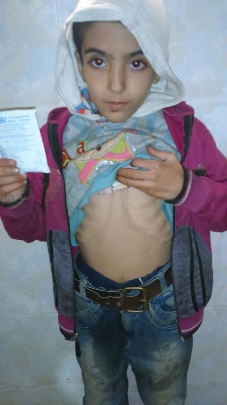 This photo received by MSNBC on Friday from a nurse, Dr. Khaled Idlibi, working at a field hospital in Madaya, Syria, shows a starving child from this western village, which is under siege by Bashar al-Assad. (Photo by Syrian American Medical Society)