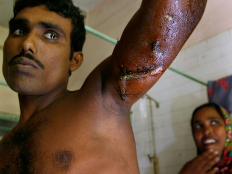 Image: Amir Naih, 32, shows the wounds inflicted by a tiger attack