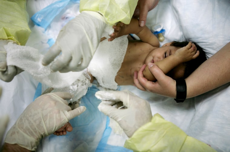 U.S. Army medical staff change the dressings on eight-month-old Saja Mahdi, who suffered severe burns from a tea kettle, at Ibn Sina Hospital in the Green Zone in Baghdad in this Dec. 12, 2007, file photo. 