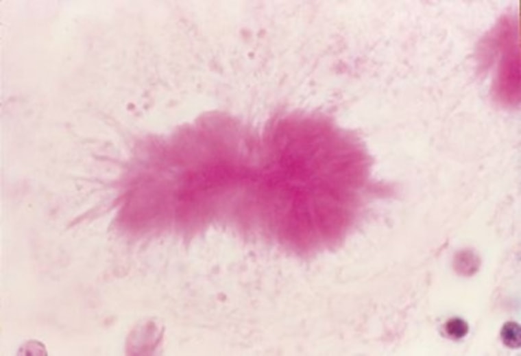 Microscopic image of a tissue sample from a human brain that shows a clump of infectious prions (dark pink area).