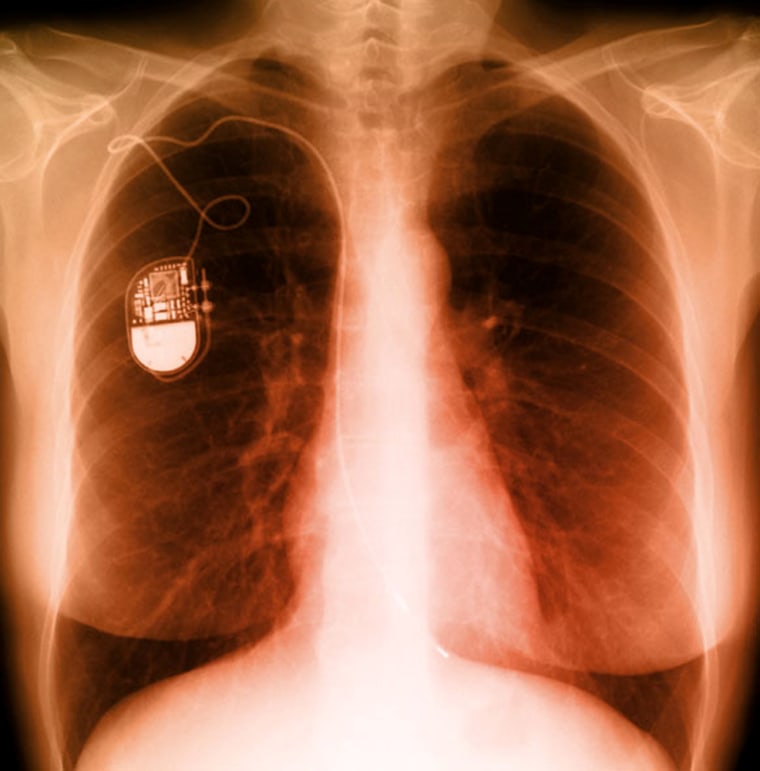 X-ray of an implanted pacemaker.