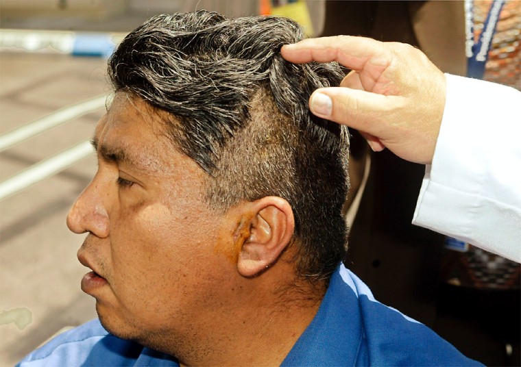 Man recovering after nails driven into skull
