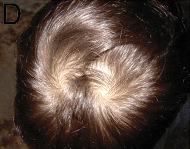 Unruly hair may be linked to a gene that determines complex hair patterns, researchers say.