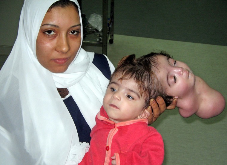 An Egyptian baby named Manar Maged lies waiting for an operation at a hospital in the city of Banha